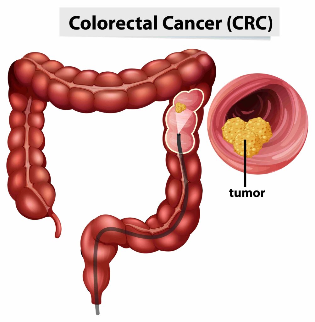 Dramatic Rise in Colorectal Cancer Seen in Children and Young Adults. Credit | Freepik